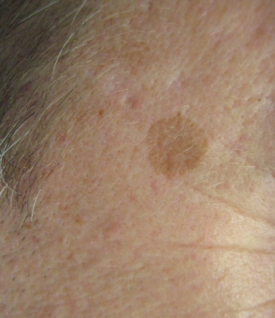 Pigmentation Reduction