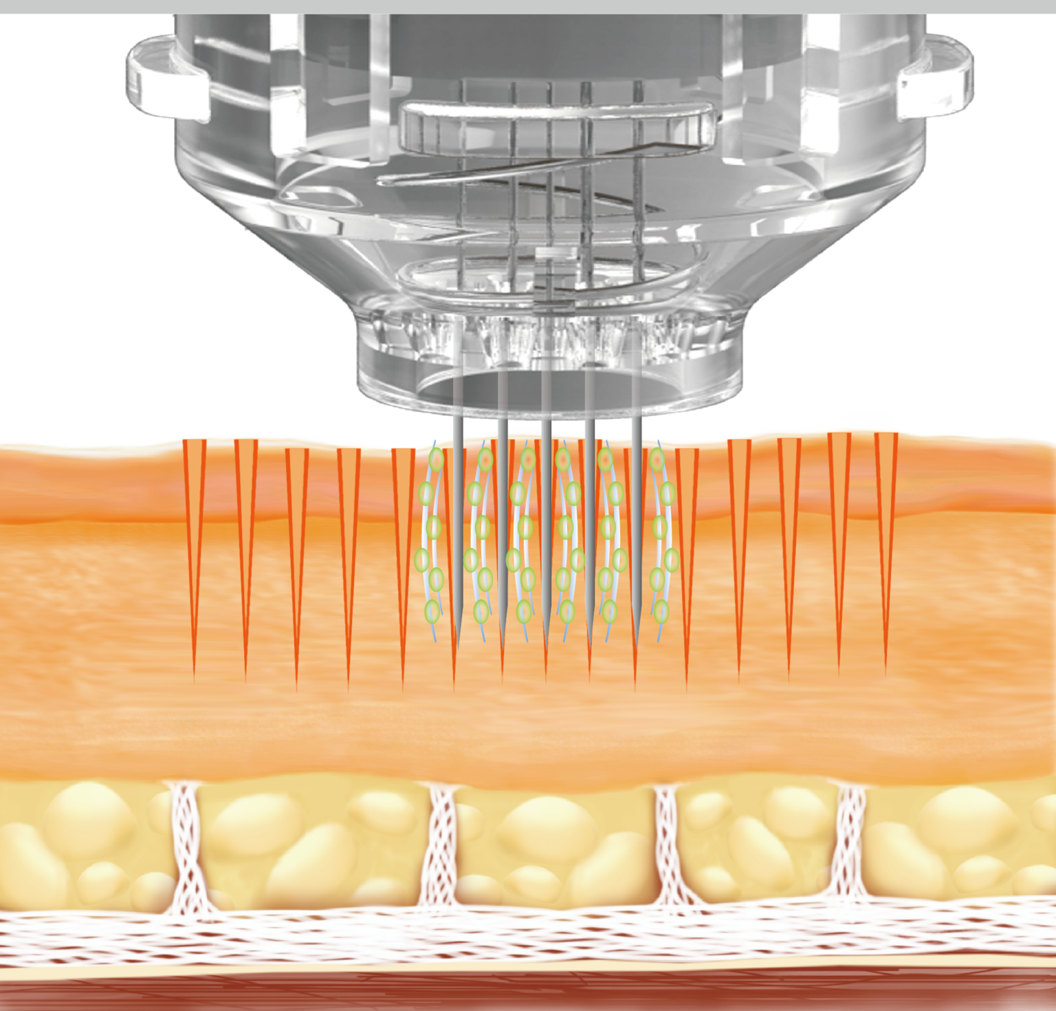 Micro-Needling